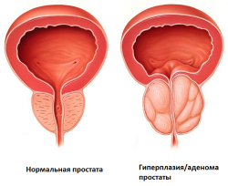 Диагностика и лечение недержания мочи у мужчин - Клиники Беларуси