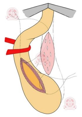 Этап дорсальной буккальной уретропластики