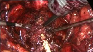 Лапароскопия простаты. Простата отсечена от мочевого пузыря, виден катетер и инструменты.