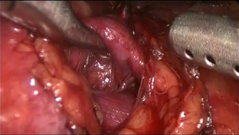 Лапароскопия почки - на инструменте почечная артерия, ниже – вена