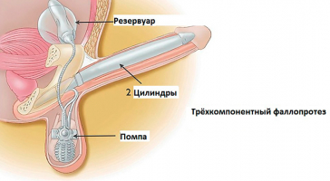 трёхкомпонентный фаллопротез при протезировании полового члена